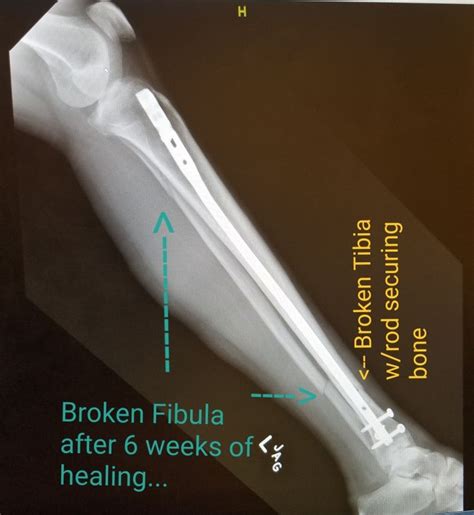 Pin On Broken Tibia And Fibula Blues 2 Bones And 3 Breaks