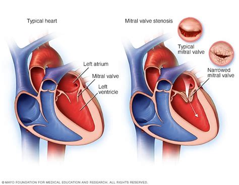 Normal Heart And Heart With Mitral Valve Stenosis Mayo Clinic
