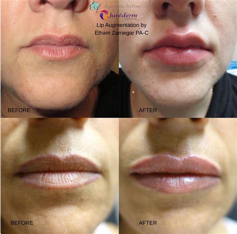Juvederm Adds Volume To The Lips And Smooths Verticals Lip Lines Before And After Photos Of 2