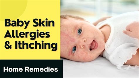 Home Remedies For Skin Allergy And Itching For Babies Must Watch