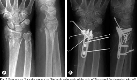 Figure 3 From Surgical Treatment Of Ulnar Metaphyseal Fracture