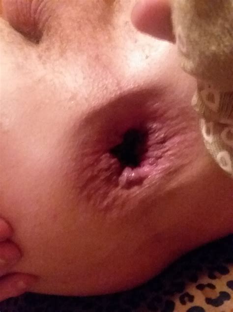 Healthool Bumps On Lips Causes Treatment Pictures Sexiz Pix