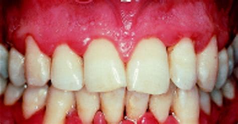 Common Dental Problem And Solution Gingivitis Cause And Management