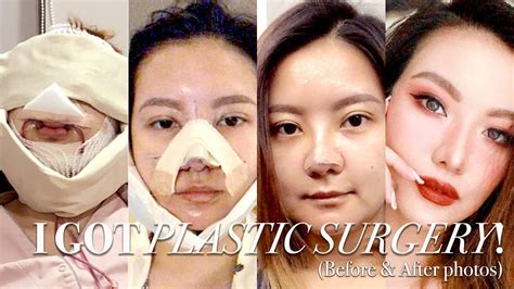 I Got Plastic Surgery In Korea Part 2 ⎮before And After Surgery