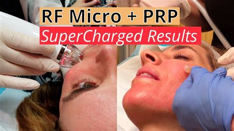 Supercharged Results Rf Micro Prp Vampire Facial Mega Upgrade For