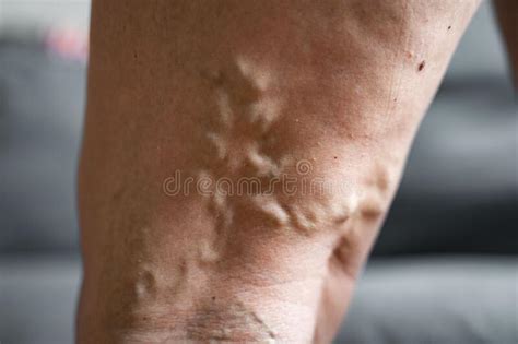 Varicose Vein Close Up Leg Senior Woman Health Problem Foot With