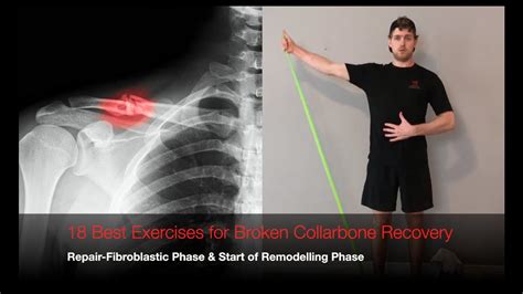 18 Best Exercises For Broken Collarbone Recovery Youtube