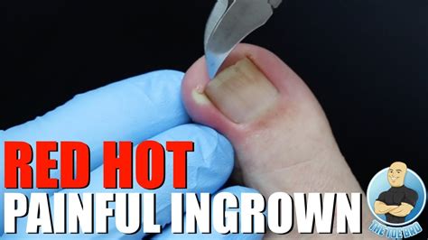 Ingrown Toenail Removal With A Gooey Surprise Youtube