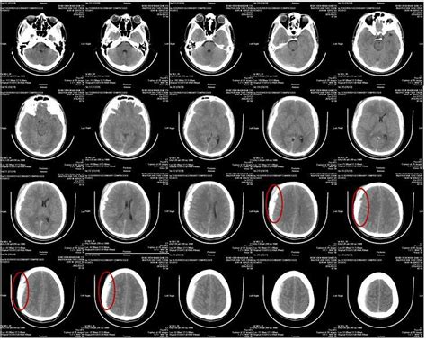 A Sample Of A Brain Hemorrhage Case Traumatic Brain Injury Download