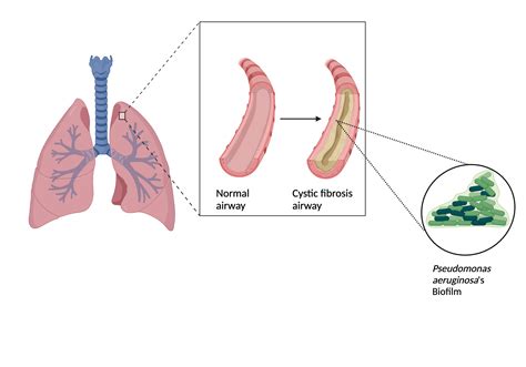 Pseudomonas Aeruginosa Biofilm In Cystic Fibrosis Patients Biorender Science Templates