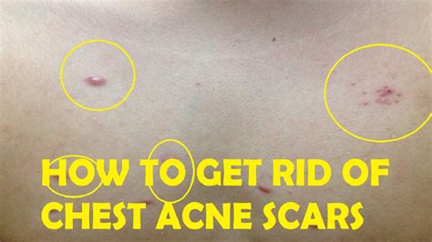 How To Get Rid Of Chest Acne Scars Fast And Easy Youtube