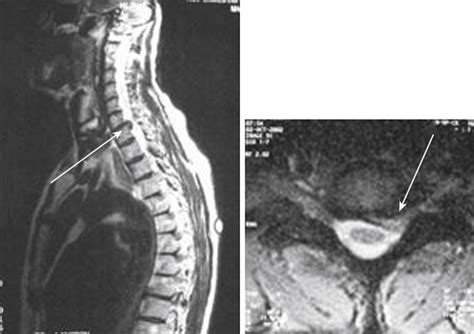 Minimally Invasive Posterior Cervical Foraminotomy And Microdiscectomy Clinical Gate