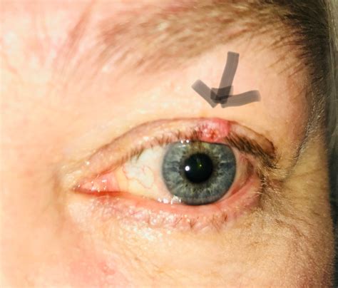 Eyelid Cancer Treatment In 2018