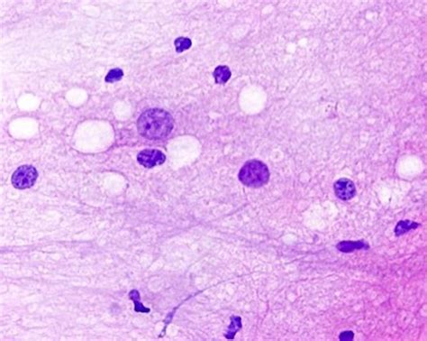 Multinodular And Vacuolating Neuronal Tumor Image