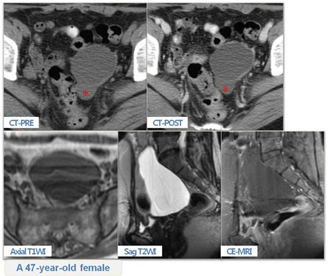 Pathogenesis, including the concept of benign metastasis in which nodal naevi are melanocytes derived from a nearby naevus. Benign Multicystic Peritoneal Mesothelioma