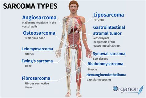 July Sarcoma Awareness Month 3d Organon