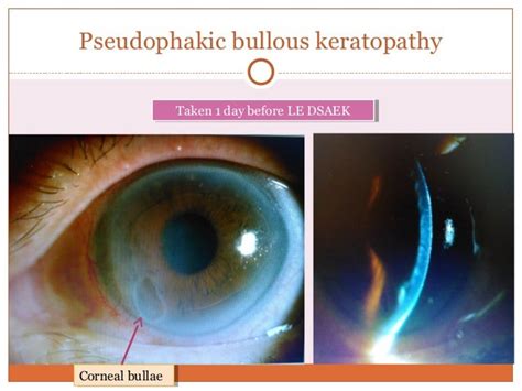 Pseudophakic Bullous Keratopathy Case
