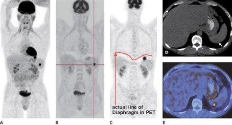 Icd 9 Code For Abnormal Pet Scan