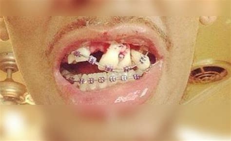 Fake Dental Braces Philippine Dental Association Issues Warning Healthtechph