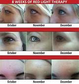 Tanning Bed Acne Treatment Pictures