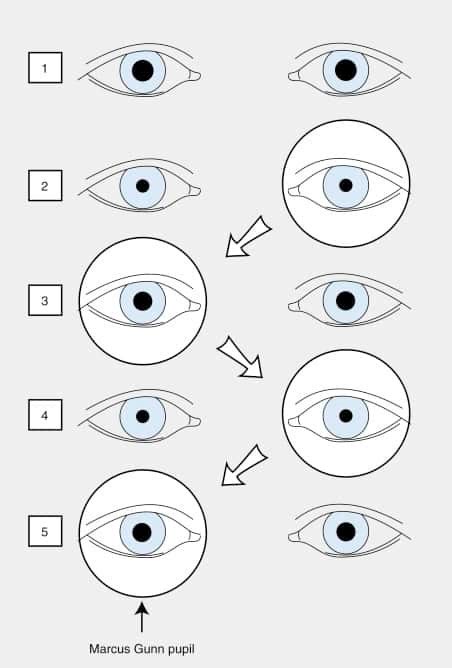 Relative Afferent Pupillary Defect Rapd Stroke Manual