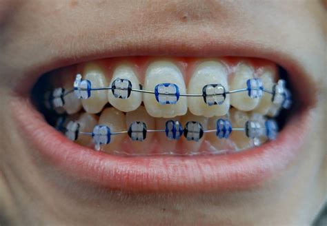 We did not find results for: Finding BonggaMom: Ten Tips for Surviving Braces