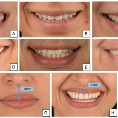 Classification Of Smile Line Smile Arc Smile Types And Upper Lip