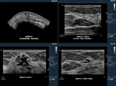 Breast Ultrasound New York Medical Imaging Diagnostic Radiology