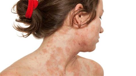 A Deeper Look At Atopic Dermatitis In Adolescents Case Study