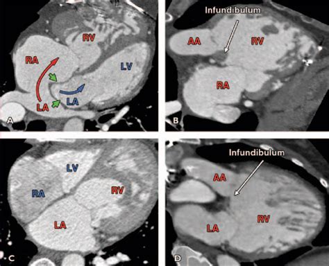 Ct Angiography Of Right Ventricular Outflow Tract Infundibulum