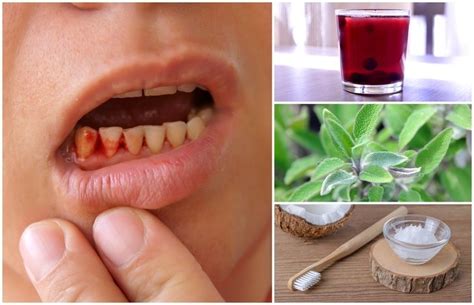 9 Best Home Remedies To Get Rid Of Gingivitis Gingivitis Remedies