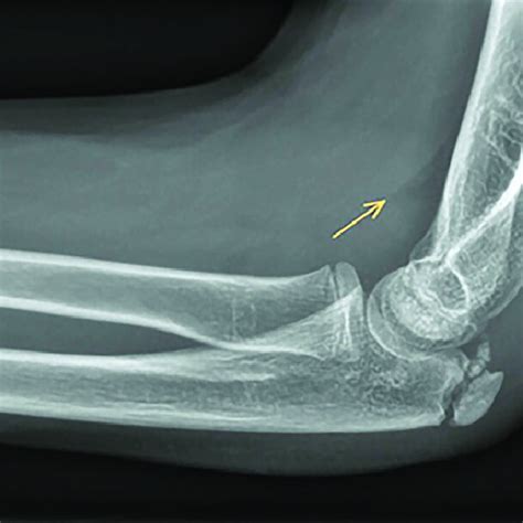 Pdf Occult Fractures In Children With A Radiographic Fat Pad Sign Of
