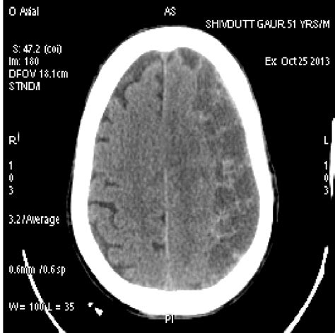 Etiology Of The Chronic Subdural Hematoma Download Sc