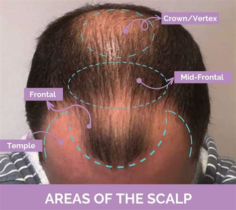 Bald Spot On Crown Causes Ways To Hide And Treatments Longevita