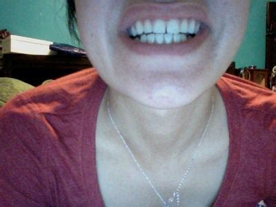 Close the gap for any missing teeth. I'm 21 and really don't want to have to get Braces for ...