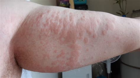Lara Rash Hives Skin Irritation Plague 100 Lara Residents Geelong