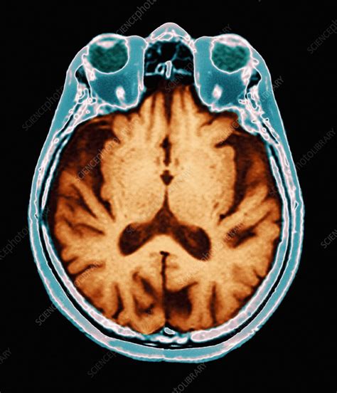 Alzheimers Disease Mri Brain Scan Stock Image M1080554 Science