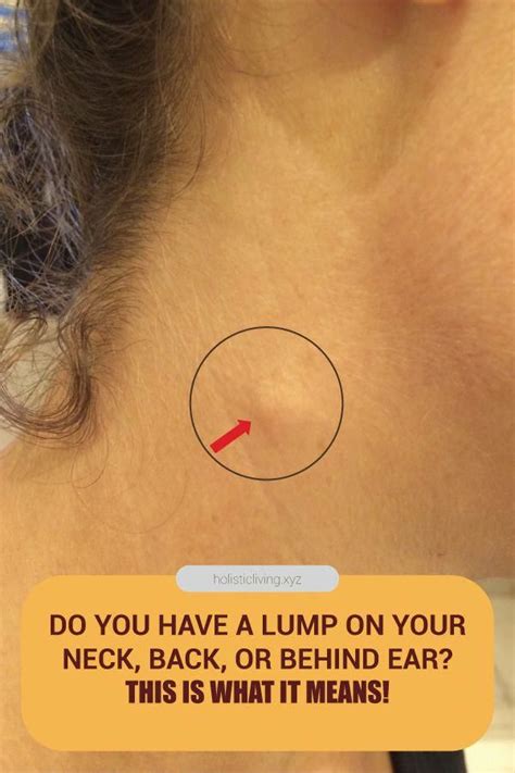 Do You Have A Lump On Your Neck Back Or Behind Your Ear This Is What