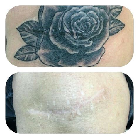 Need advice about going private? Cover up tattoo over a knee scar