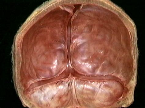 Venous sinuses: sagittal, transverse, sigmoid | Acland's Video Atlas of
