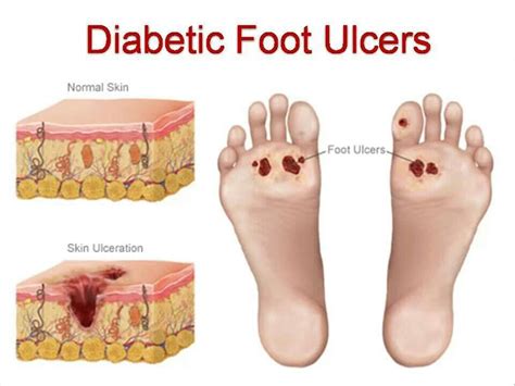 Diabetic Ulcers Causes Symptoms Preventions And Treatments