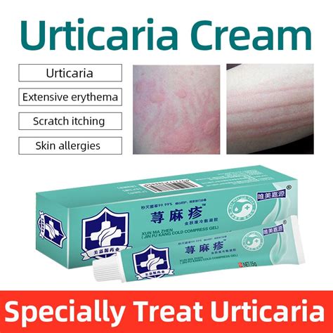 Herbal Medicine Urticaria Ointment Treatment Skin Dermatitis Psoriasis