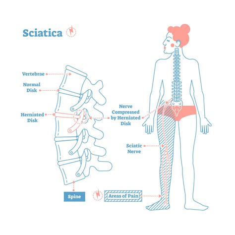 Additionally, if lateral curvature in this area has been there for quite some time, the facets will. Sciatica Symptoms