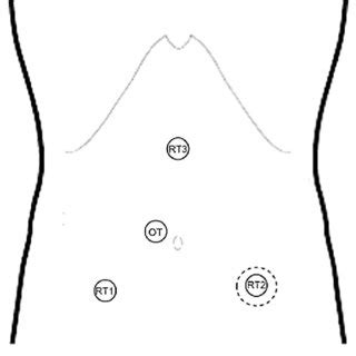 Schematic Of The Trocar Placement Robotic Trocars RT RT Download Scientific