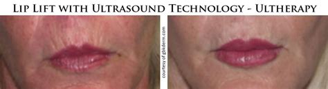 Non Invasive Lip Lift With Ultherapy Coastal Valley Dermatology