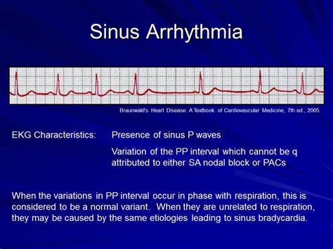 Arrhythmias And Ekgs Part 2 Outline Sinus Arrhythmia