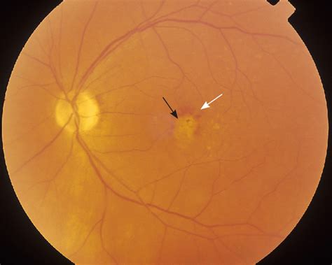 Wet Exudative Or Neovascular Age Related Macular Degeneration With