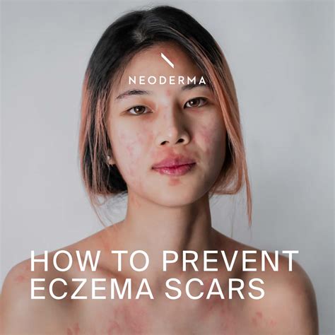 How To Prevent Eczema Scars Neoderma