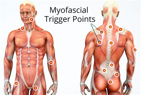 Muscle Knots Myofascial Trigger Points