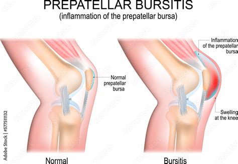 Prepatellar Bursitis Inflammation Of The Prepatellar Bursa Comparison Of A Human Knee With